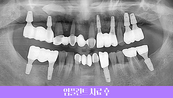 60대 임플란트 치료사례