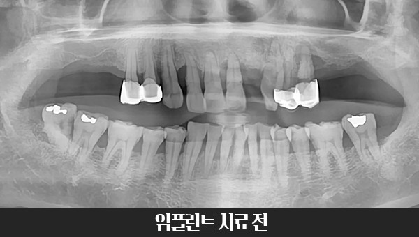 60대 임플란트 치료사례