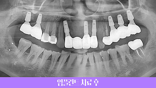 60대 임플란트 치료사례