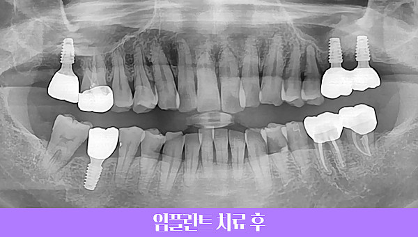 40대 임플란트 치료사례