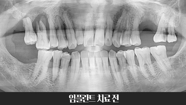 50대 임플란트 치료사례