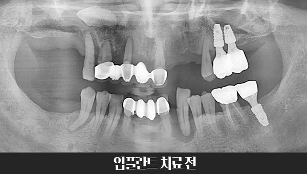 60대 임플란트 치료사례