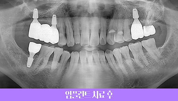 50대 임플란트 치료사례