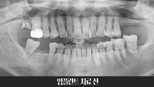 40대 임플란트 치료사례