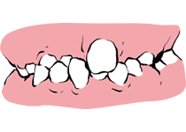 윗니와 아랫니가 엇갈리게 났어요