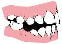 어금니가 반대로 물려요